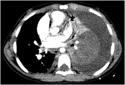 Necrotizing pneumonia in children: Chest computed tomography vs. lung ultrasound